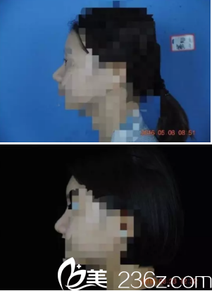 側(cè)面鼻子圖