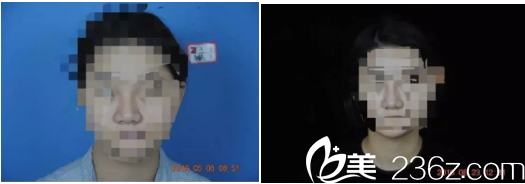 正面隆鼻失敗對比圖