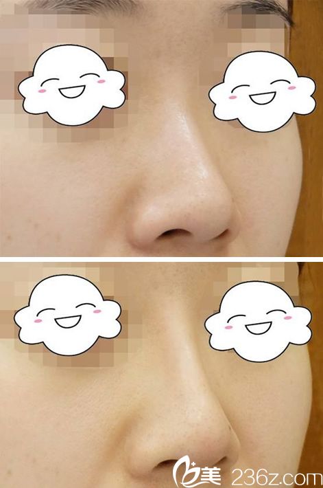 衢州雪榮醫(yī)院打玻尿酸隆鼻案例 衢州雪榮醫(yī)院打玻尿酸隆鼻案例