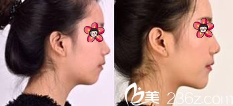 衢州雪榮醫(yī)院注射玻尿酸豐下巴案例 衢州雪榮醫(yī)院注射玻尿酸豐下巴案例