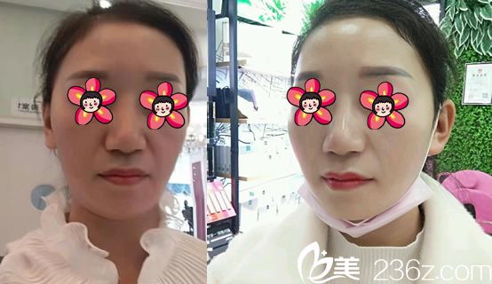 衢州雪榮醫(yī)院祝少華面部線雕案例 衢州雪榮醫(yī)院祝少華面部線雕案例