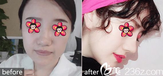 <!--<i data=20240703-sp></i>-->整形醫(yī)院隆鼻案例 <!--<i data=20240703-sp></i>-->整形醫(yī)院隆鼻案例