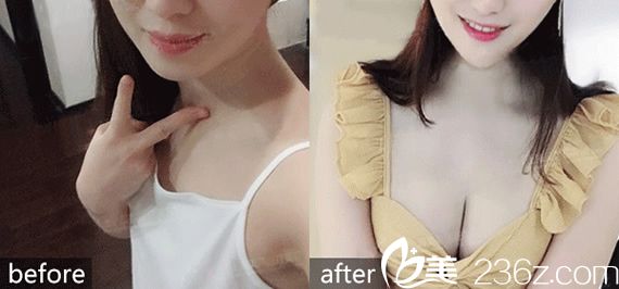 <!--<i data=20240703-sp></i>-->整形醫(yī)院隆胸案例 <!--<i data=20240703-sp></i>-->整形醫(yī)院隆胸案例