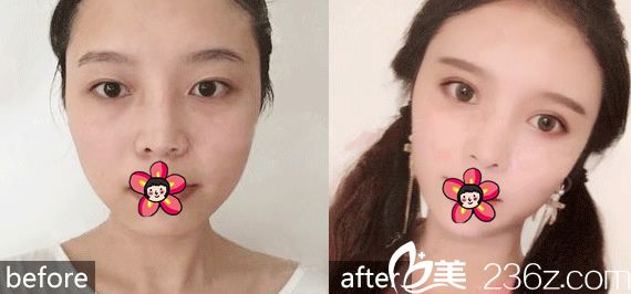 <!--<i data=20240703-sp></i>-->整形醫(yī)院雙眼皮案例 <!--<i data=20240703-sp></i>-->整形醫(yī)院雙眼皮案例