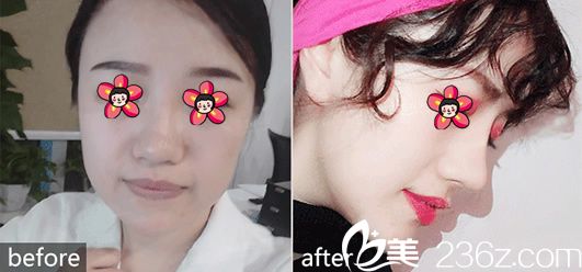 整形馮利光鼻綜合案例