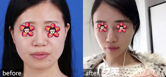 謝劍自體脂肪填充案例