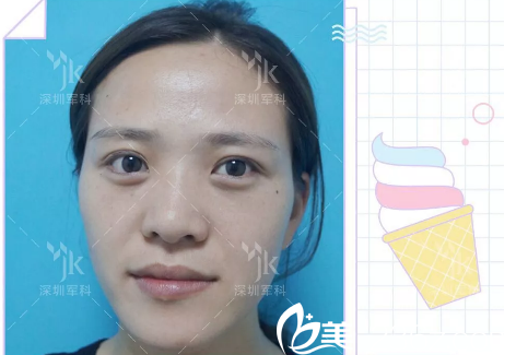 脂肪填充術(shù)前照片 脂肪填充術(shù)前照片