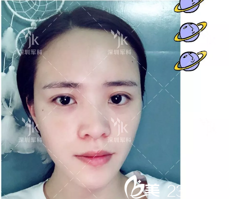 自體脂肪填充術(shù)后7天效果 自體脂肪填充術(shù)后7天效果