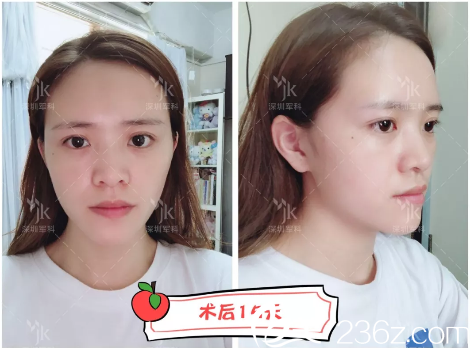 劉月更自體脂肪填充15天效果 劉月更自體脂肪填充15天效果