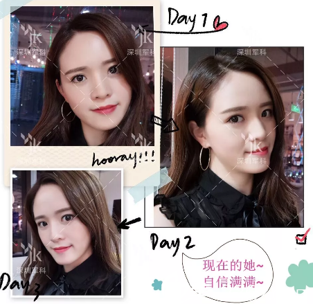 對比了深圳軍科和陽光整形醫(yī)院的案例后找劉月更做了自體脂肪全臉填充