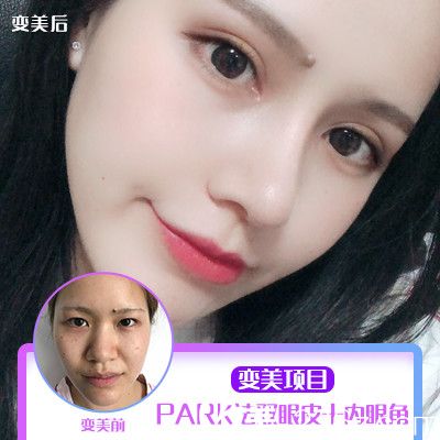 梅州愛(ài)麗諾雙眼皮隆鼻案例