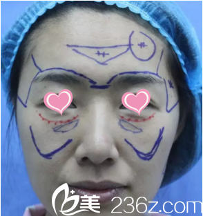 面診了煙臺(tái)華怡后選擇了美神整形醫(yī)院做自體脂肪填充面部手術(shù)，父母沒有一點(diǎn)反對(duì)