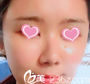 恢復20天后的面部情況 恢復20天后的面部情況