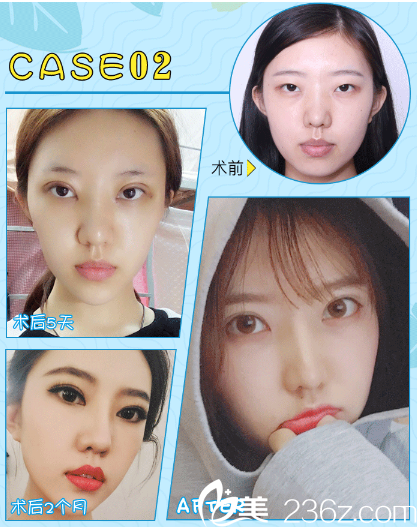 廣州曙光范丹的雙眼皮案例 廣州曙光范丹的雙眼皮案例