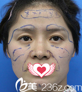 自體脂肪填充面部術(shù)前照片 自體脂肪填充面部術(shù)前照片