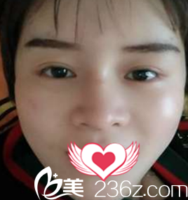 術(shù)后第5天 術(shù)后第5天