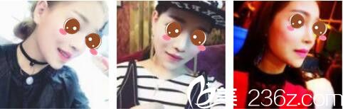 韓國女神整形醫(yī)院金鎮(zhèn)亨下頜角磨骨真人案例術(shù)后十五天 韓國女神整形醫(yī)院金鎮(zhèn)亨下頜角磨骨真人案例術(shù)后十五天