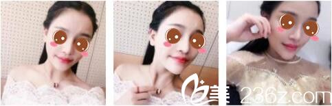 韓國女神整形醫(yī)院金鎮(zhèn)亨下頜角磨骨真人案例術(shù)后兩個月 韓國女神整形醫(yī)院金鎮(zhèn)亨下頜角磨骨真人案例術(shù)后兩個月