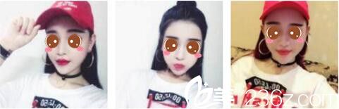 聽說在韓國女神找金鎮(zhèn)亨做面部輪廓三件套才不到六萬，于是我來做了下頜角磨骨