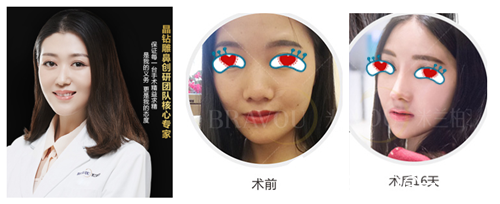 看成都米蘭柏羽隆鼻好嗎 看成都米蘭柏羽隆鼻好嗎