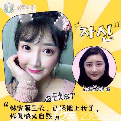 廣州紫馨李政祐雙眼皮案例