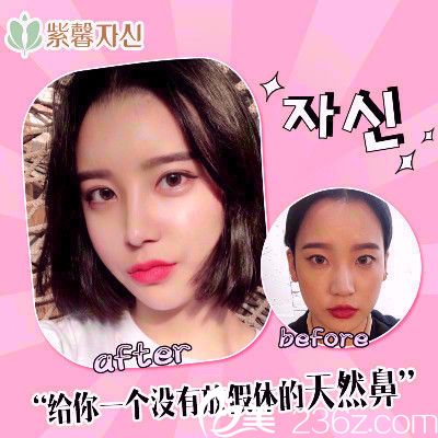 廣州紫馨李政祐雙眼皮隆鼻案例