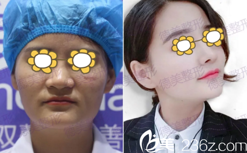 鼻整形真人前后對比 鼻整形真人前后對比