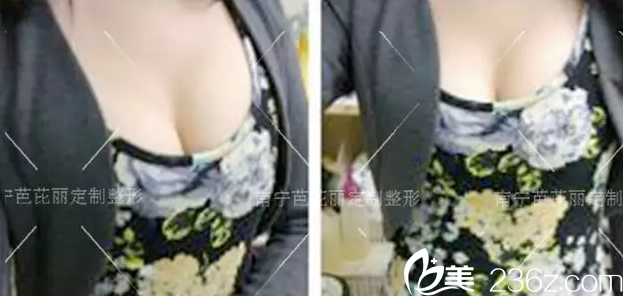 美女老師選擇在南寧芭芘麗做了自體脂肪豐胸術(shù)后罩杯從A升到C