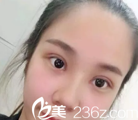 雙眼皮痕跡很淺