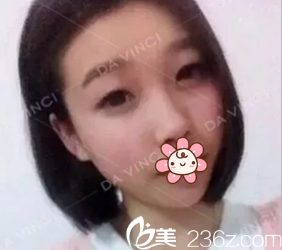 雙眼皮開眼角術(shù)前照片 雙眼皮開眼角術(shù)前照片