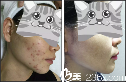 祛痘真人前后效果展示 祛痘真人前后效果展示