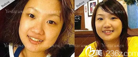 在溫州yestar做眼睛鼻子和牙齒前 在溫州yestar做眼睛鼻子和牙齒前