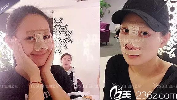 剛做完眼睛和鼻子手術(shù)照片 剛做完眼睛和鼻子手術(shù)照片