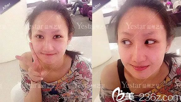 做完雙眼皮和隆鼻5天拆線<span style= 做完雙眼皮和隆鼻5天拆線<span style=