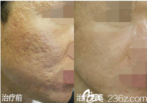 韓國BLS醫(yī)院祛痘印案例對比圖