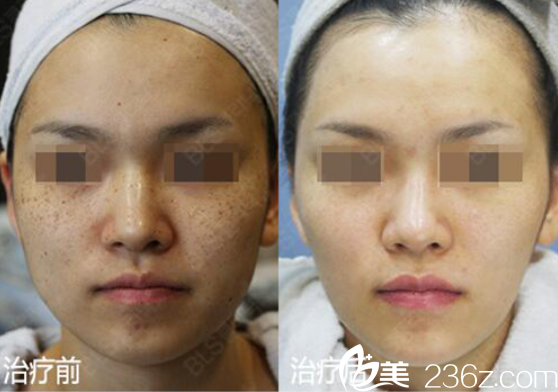 韓國BLS整形外科醫(yī)院祛色素對比圖