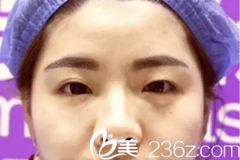 做顯微精雕電眼術(shù)術(shù)前照 做顯微精雕電眼術(shù)術(shù)前照