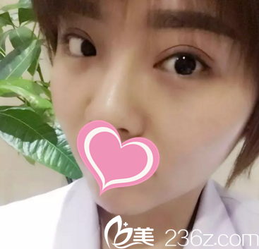 聽說懷化德美整形符恒做雙眼皮很厲害，于是我找他做了顯微精雕電眼術(shù)，效果真沒讓我失望！