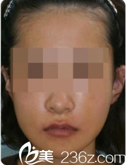 日本哪位醫(yī)生擅長(zhǎng)下巴整形?分享小木曾佑一醫(yī)生下巴削骨術(shù)手術(shù)真實(shí)經(jīng)過，帶你走進(jìn)日本小木曾(Kogiso)美容整形醫(yī)院