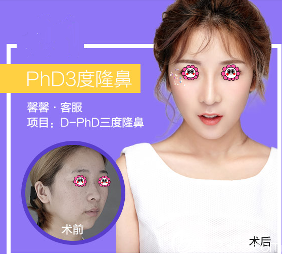 北京米蘭柏羽麗都吳玉家假體隆鼻