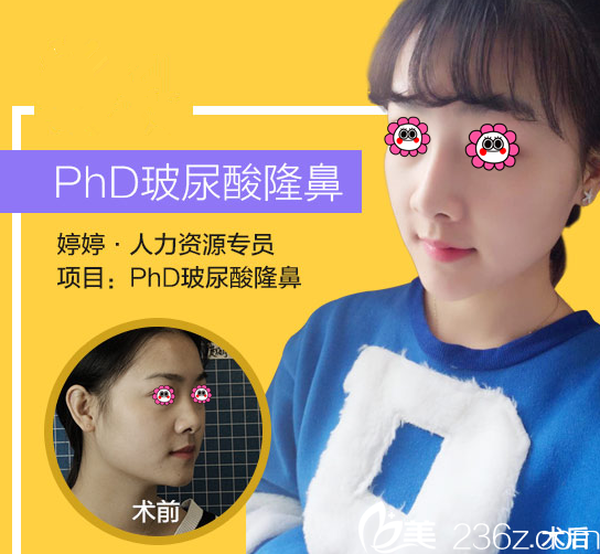 北京米蘭柏羽麗都曹令玻尿酸隆鼻