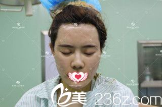 杜建龍醫(yī)生做脂肪填充術(shù)后即刻效果面部很飽滿