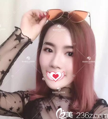 杜建龍醫(yī)生為我做面部脂肪填充后已經(jīng)完全消腫