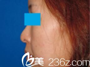 小木曾佑一隆鼻手術前 小木曾佑一隆鼻手術前