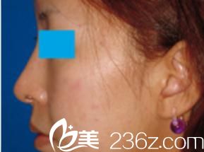 小木曾佑一醫(yī)生醫(yī)生到底怎么樣?說說我在Kogiso Clinic 做的硅膠隆鼻手術(shù)，宛如換臉!