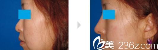 小木曾佑一隆鼻手術前后對比 小木曾佑一隆鼻手術前后對比