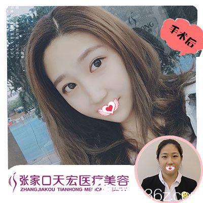 張家口天宏做雙眼皮案例 張家口天宏做雙眼皮案例