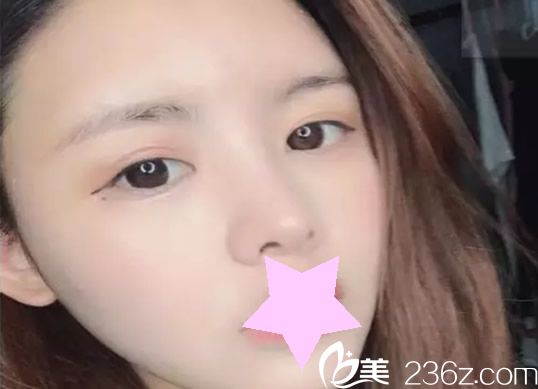 周誠面部吸脂第7天 周誠面部吸脂第7天