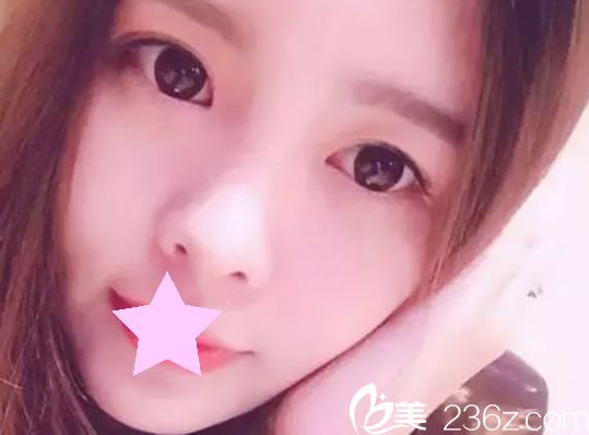 大餅?zāi)?、嬰兒肥在昆明美伊萊整形周誠(chéng)院長(zhǎng)的面部吸脂術(shù)后笑靨如花