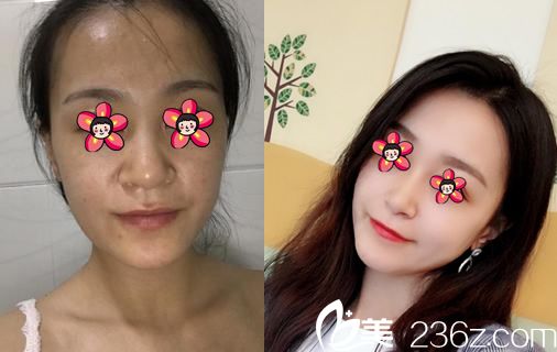 寧波時(shí)光美極孫震做鼻翼縮小案例 寧波時(shí)光美極孫震做鼻翼縮小案例